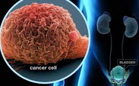 Bladder Cancer Therapies