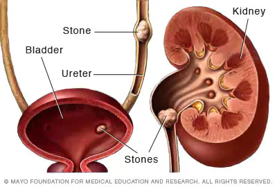 Kidney Stone Removal