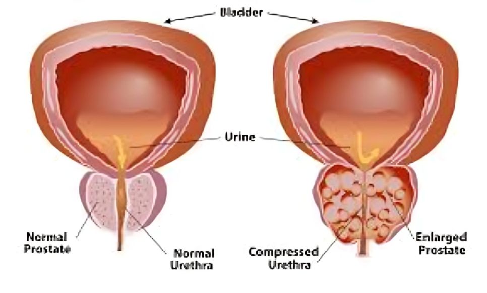 Prostate Health Solutions