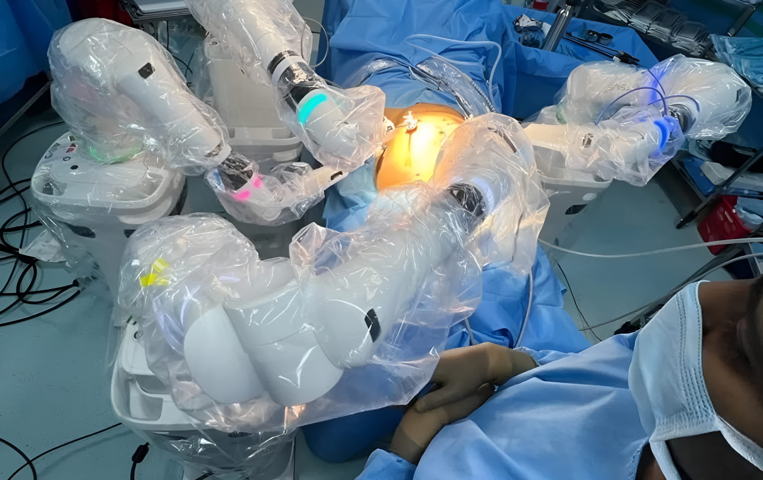 Robotic surgery setup in the operating room